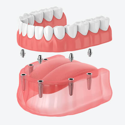 implants